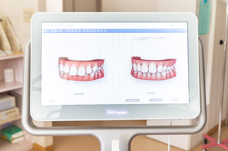 当院が導入する光学3Dカメラ（iTero）による歯型取り